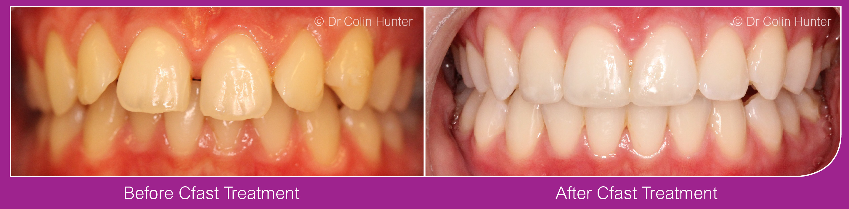 cfast teeth straightening
