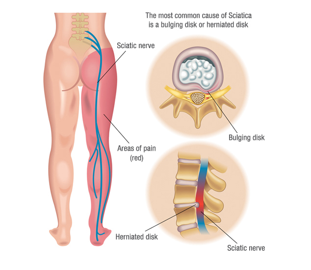 Kneeling chair and sciatica, does it help? Any experiences? : r/Sciatica