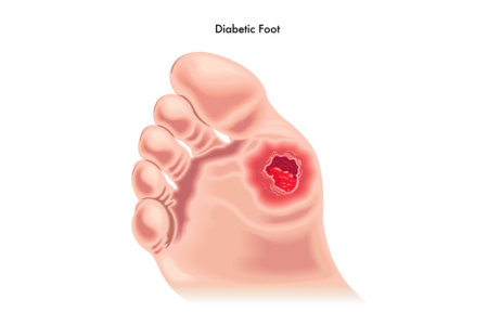 Living Well with Diabetes and How to Care for your Feet the Supplefeet Way