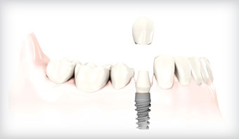 Discover the Benefits of Dental Implants to Replace Missing Teeth