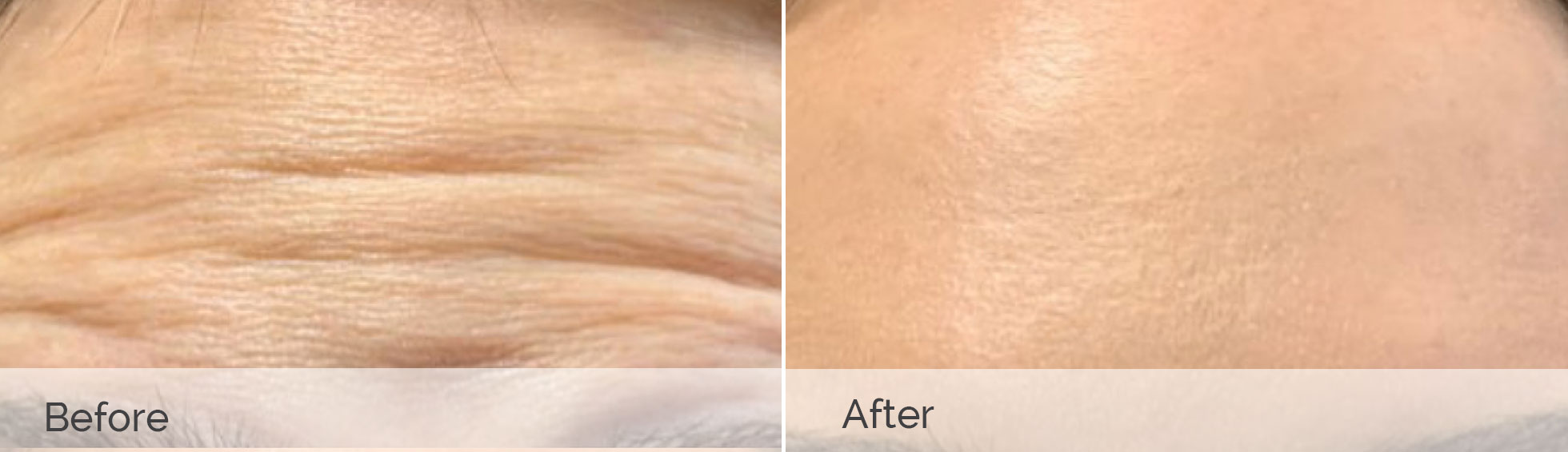 Wrinkle Reduction
