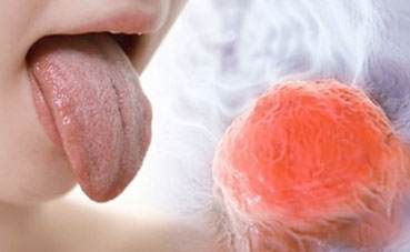 Tongue Cancer Warning - the Symptoms you Shouldn't be Ignoring