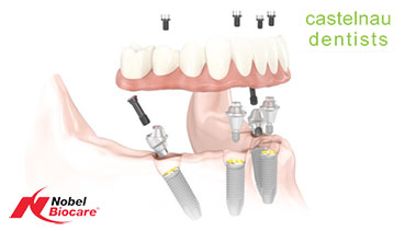 What are All-on-4 Dental Implant Dentures
