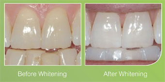 Before & after teeth whitening images