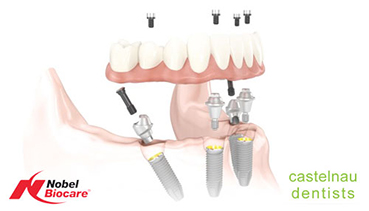 What are Dental Implant Dentures (All-on-4)?